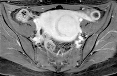 Before treatment [T1 Gd]