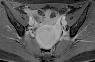 Before treatment [T1 Gd]