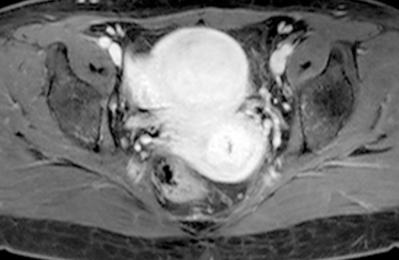 Before treatment [T1 Gd]