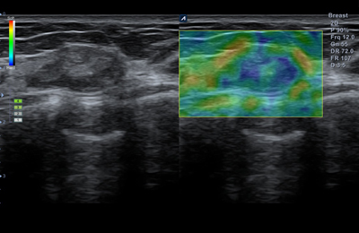 Elastography
