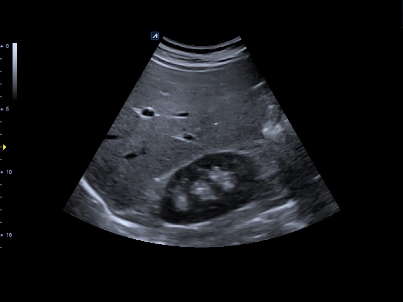 Kidney in 2D Mode