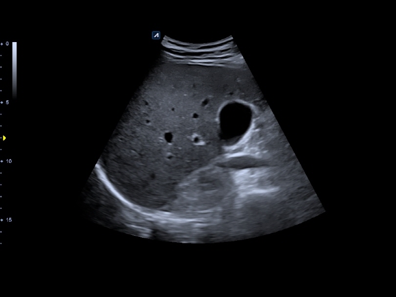 Liver and gallbladder in 2D Mode