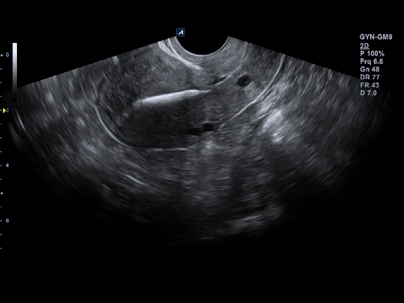 Intrauterine device(IUD) in 2D Mode
