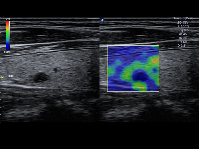Thyroid nodule in Elastography