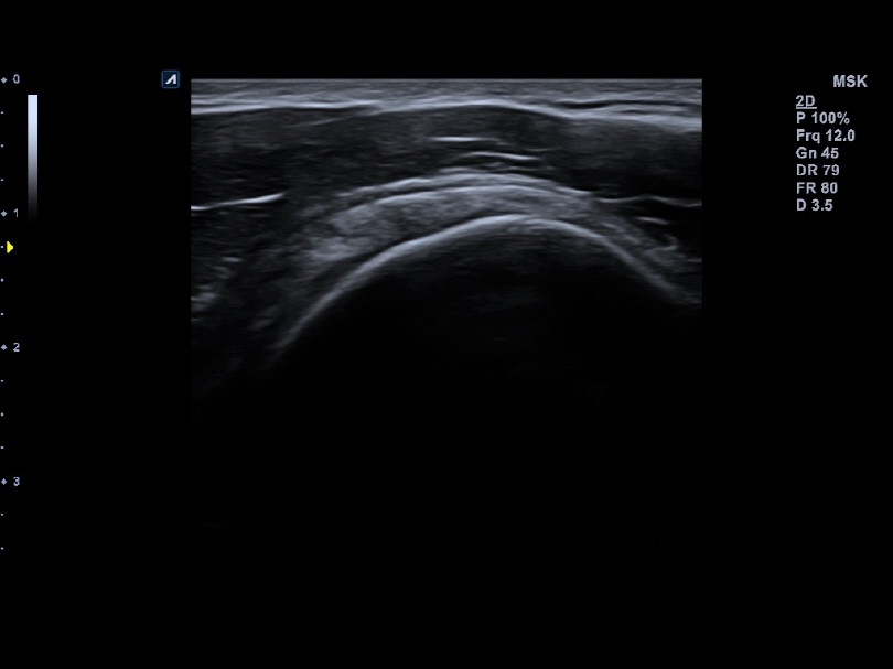 Shoulder in 2D Mode