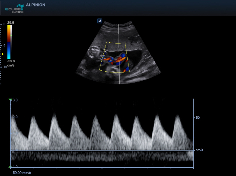Umbilical Cord in PW Mode