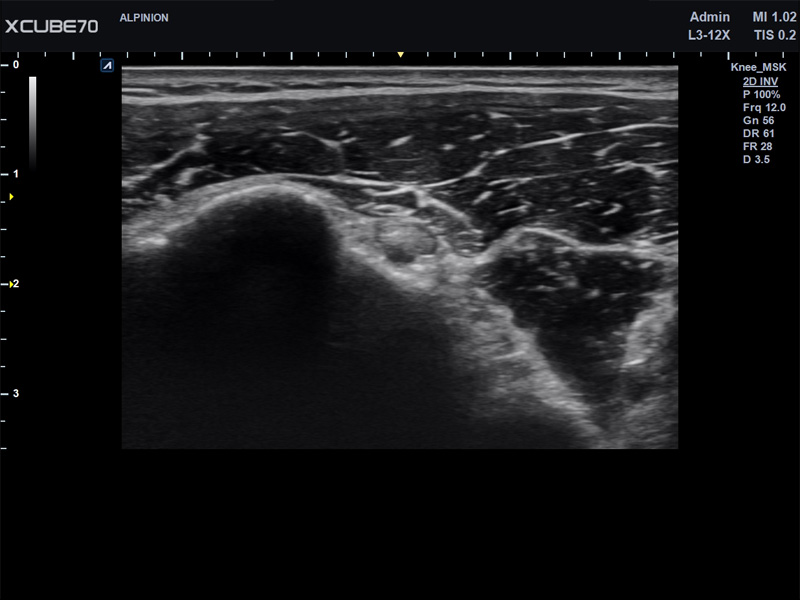 Umbilical Cord in PW Mode