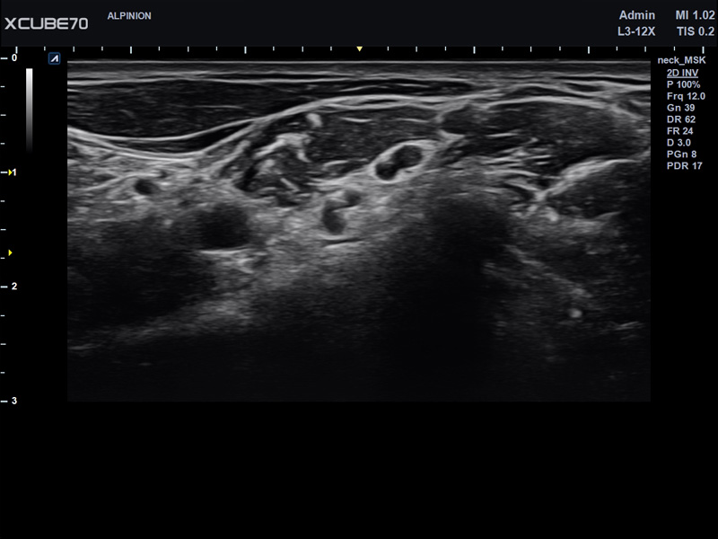 Umbilical Cord in PW Mode