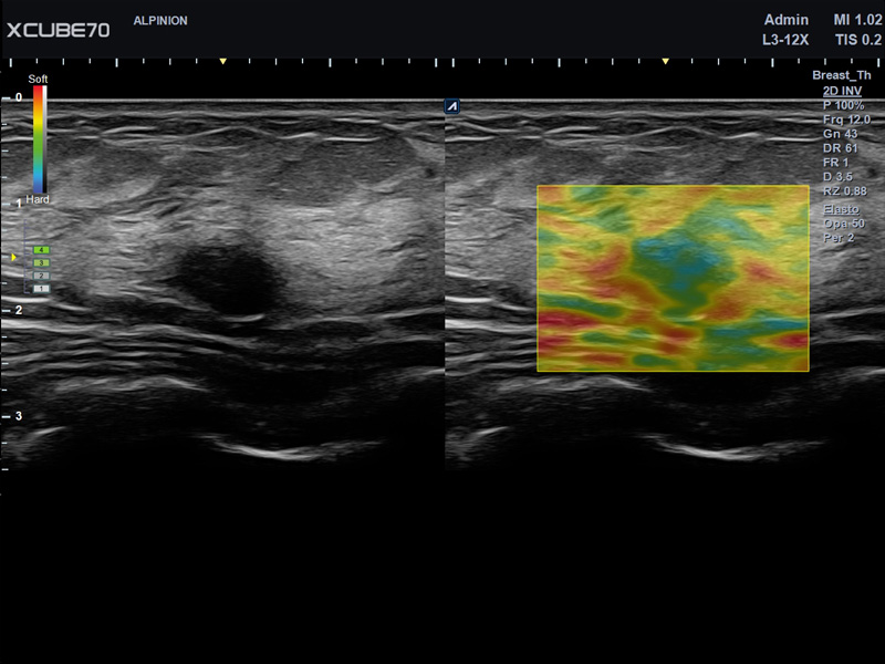 Umbilical Cord in PW Mode