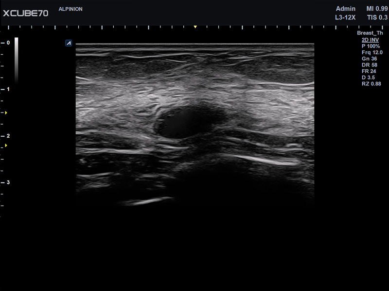 Umbilical Cord in PW Mode
