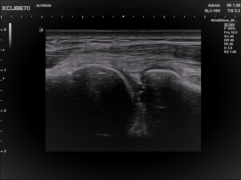 Umbilical Cord in PW Mode