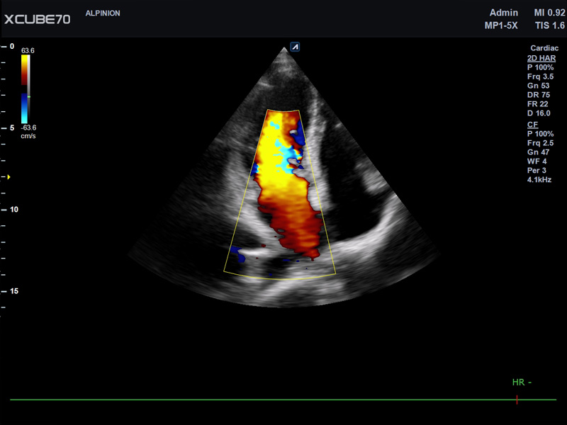 Umbilical Cord in PW Mode