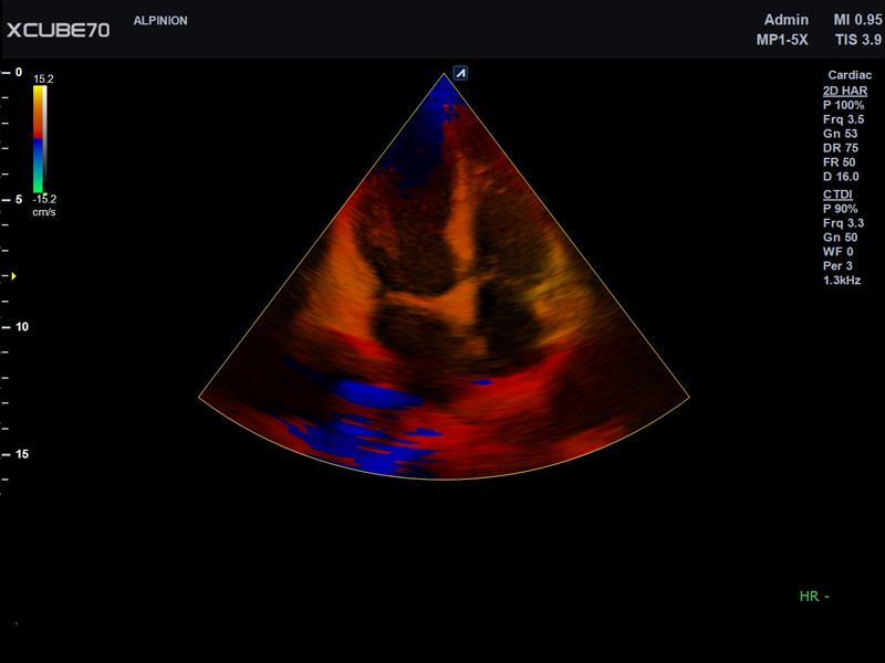 Umbilical Cord in PW Mode