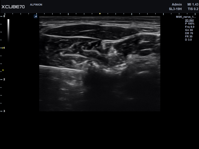 Umbilical Cord in PW Mode