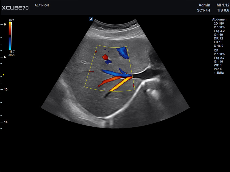 Umbilical Cord in PW Mode