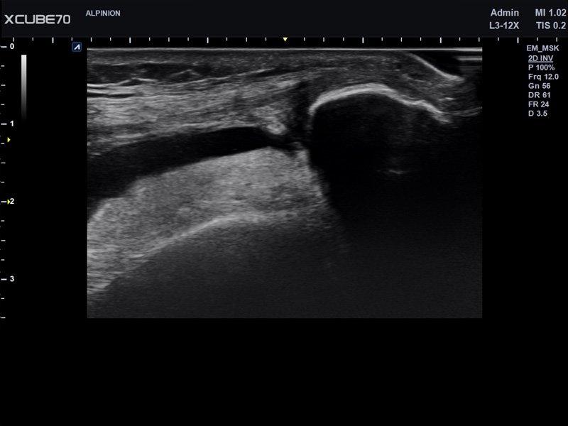 Umbilical Cord in PW Mode