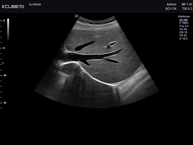 Umbilical Cord in PW Mode