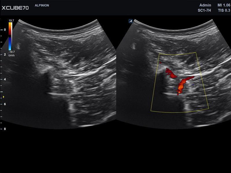 Umbilical Cord in PW Mode