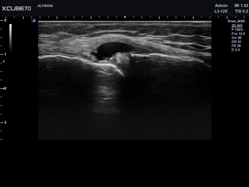 Umbilical Cord in PW Mode