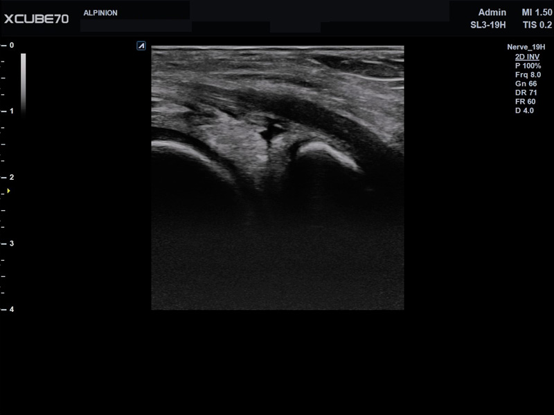 Umbilical Cord in PW Mode