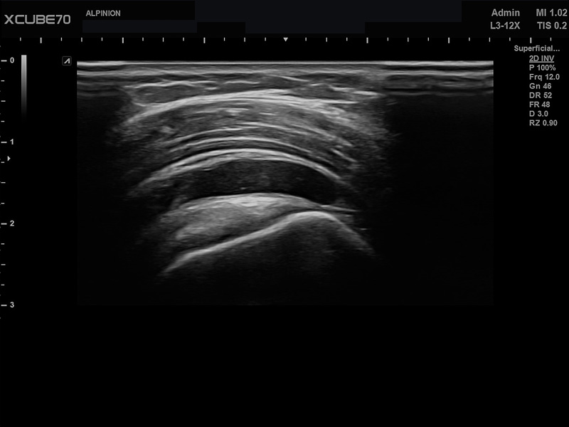 Umbilical Cord in PW Mode