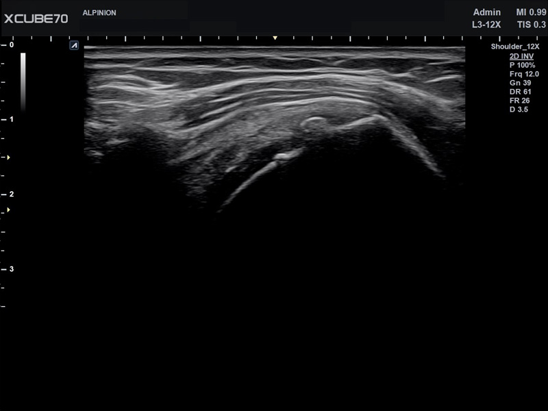 Umbilical Cord in PW Mode
