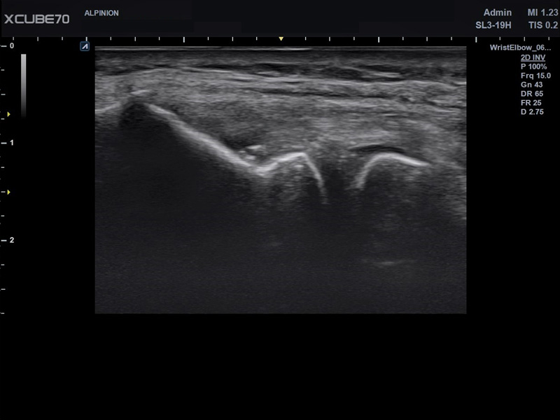 Umbilical Cord in PW Mode