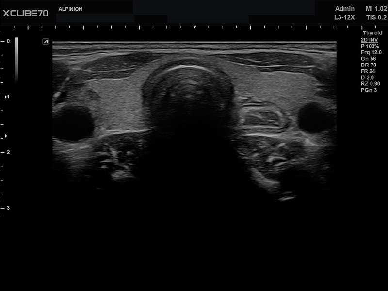 Umbilical Cord in PW Mode