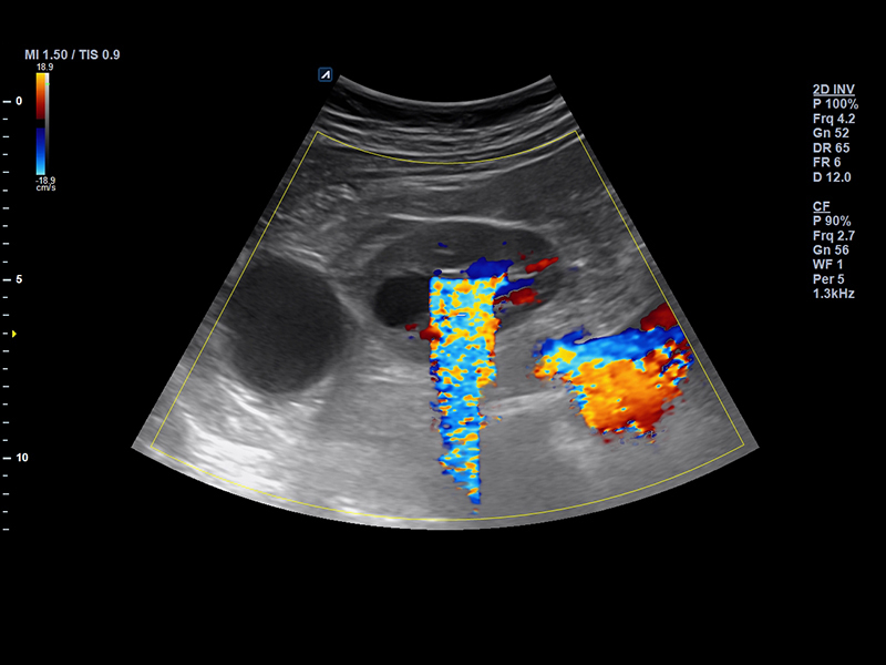 Kidney(Renal stone)_Color mode_Twinkle artifact