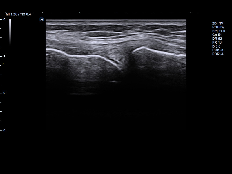 Knee meniscus_2D